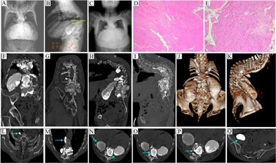 Multiple Spinal Tuberculosis with Severe Kyphosis: A Case Report